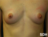Patient # 56886 Before Photo # 1